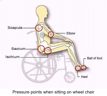 Pressure points when siting on wheel chair