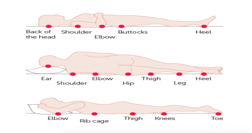 How does a Pressure Injury occur?