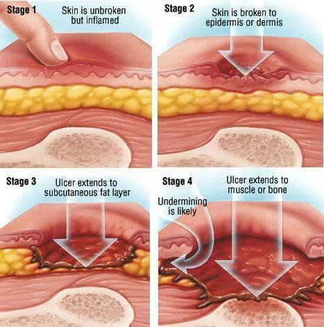 Stages of Pressure Injury