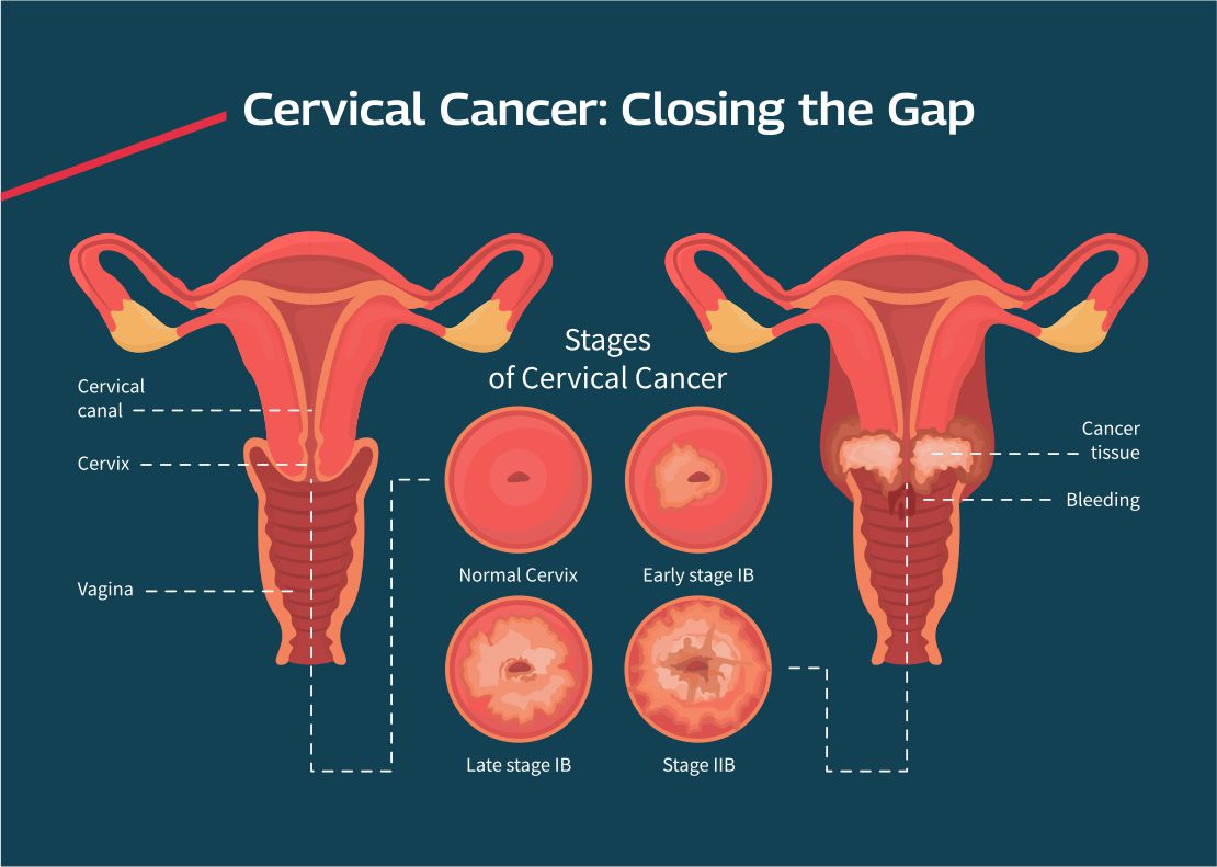 Cervical Cancer: Closing the Gap